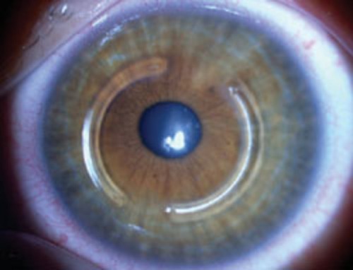 KERATACx™ Intracorneal Ring Implants » IMT