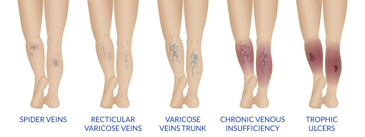 Varicose Veins: Causes, Stages, Symptoms, Treatment | HSMC AE