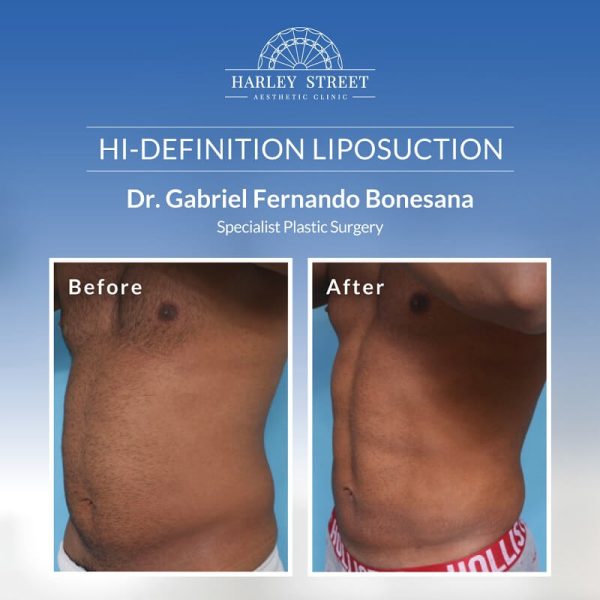 Dr. Bonesana-HD Liposuction Before After