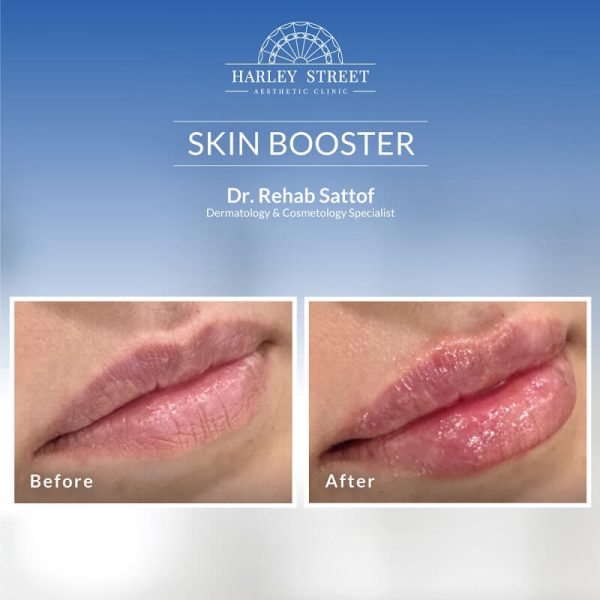 Skin Booster Dr. Rehab Abu Dhabi