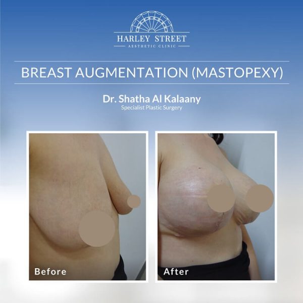 Breast Augmentation Before-After