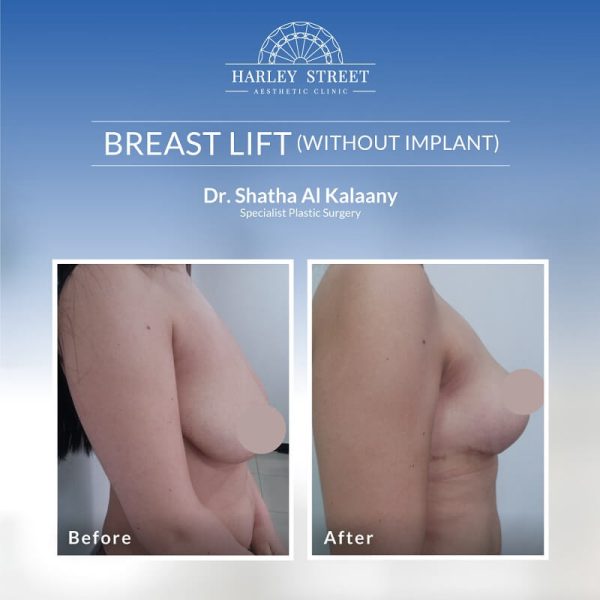 Breast Lift Dr.-Shatha-Before-After