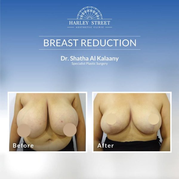 Breast Reduction Dr.-Shatha-Before-After