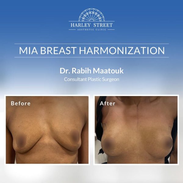 MIA Breast Surgery