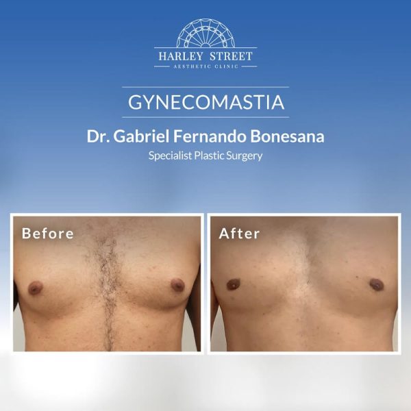 Gynecomastia Abu Dhabi Result