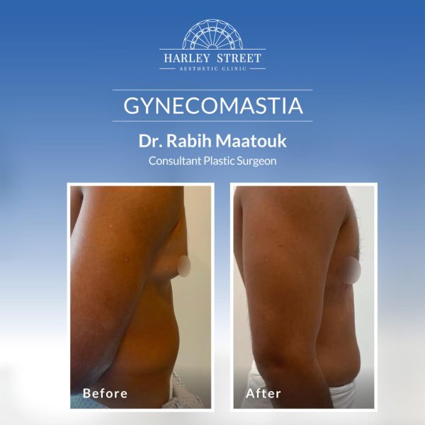 Gynecomastia Before After Abu Dhabi