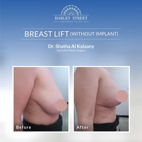 Breast Lift without Implant