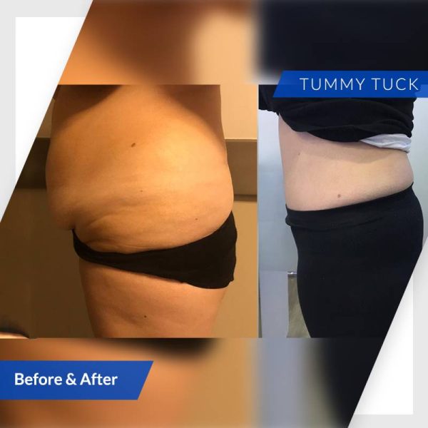 tummy tuck Abu Dhabi before-after