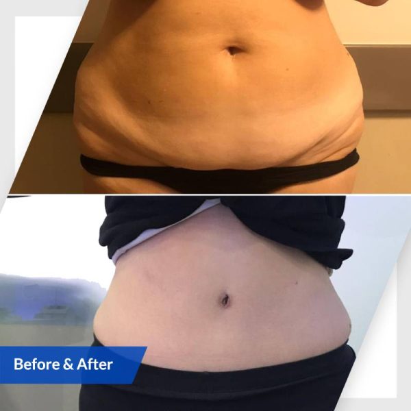 tummy tuck HSMC