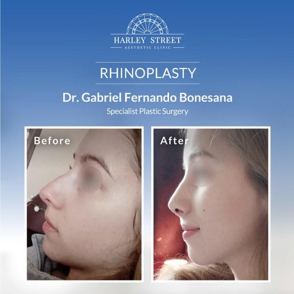 Rhinoplasty